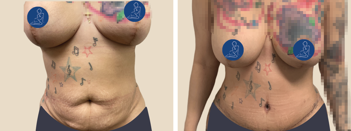 Prevenir una infección después de una abdominoplastia - Spanish Hourglass  Tummy Tuck