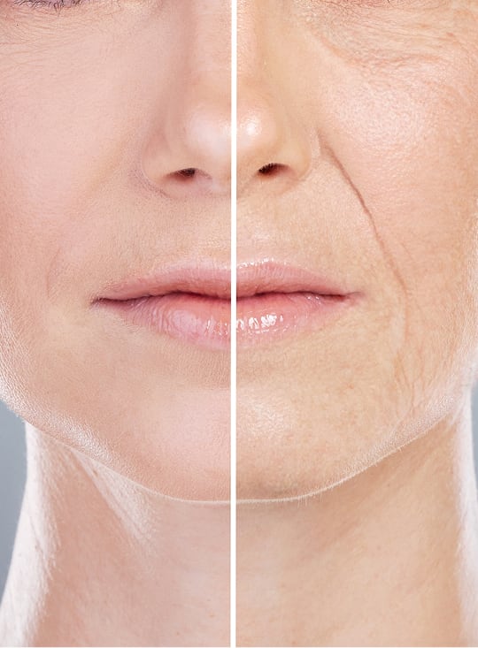 Facelift