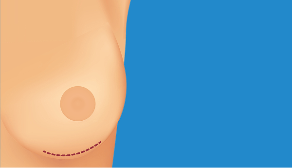 breast augmentation 