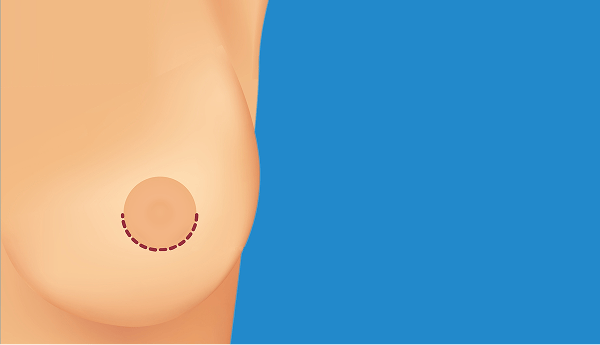 breast augmentation 