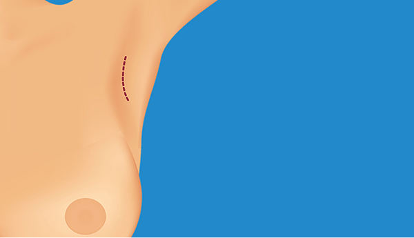breast augmentation 