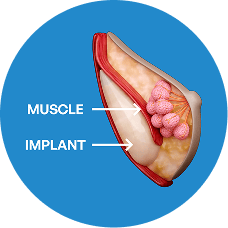 breast augmentation 