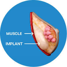 breast augmentation 
