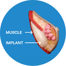 breast augmentation 