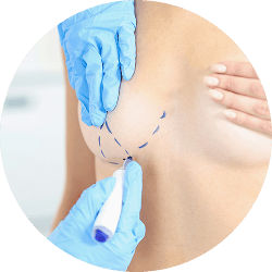 breast lift