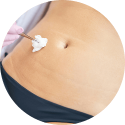 liposuction