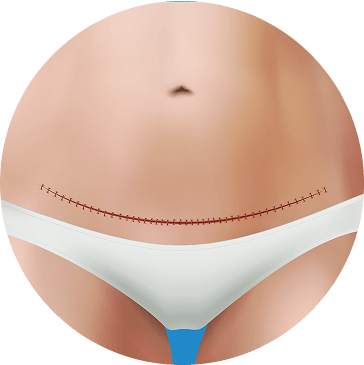 tummy tuck  