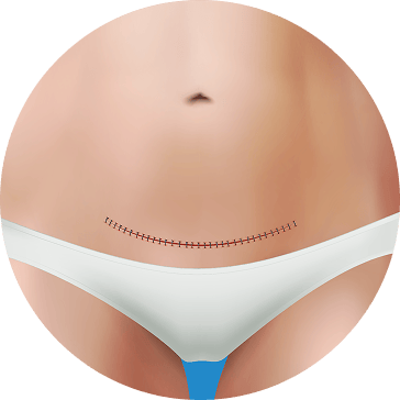 tummy tuck  