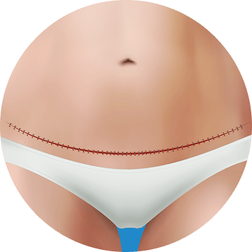 tummy tuck  