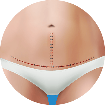 tummy tuck  