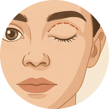 blepharoplasty 