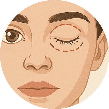 blepharoplasty 