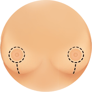 breast lift 