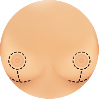 breast lift 