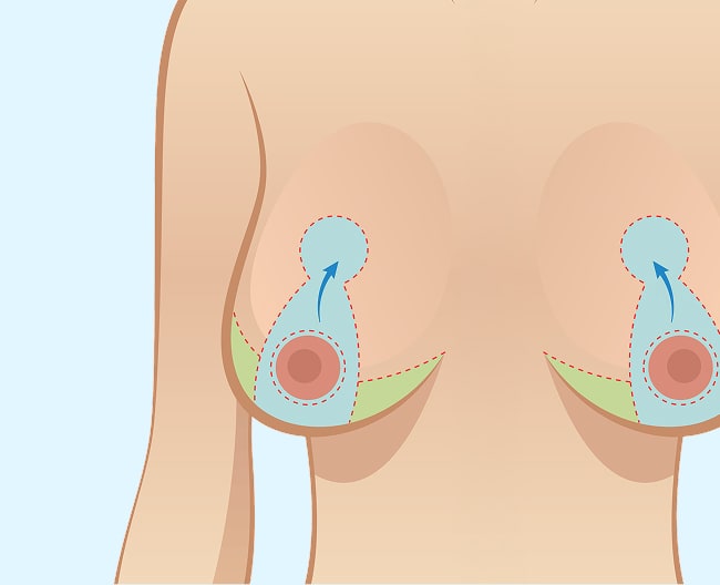 breast lift 