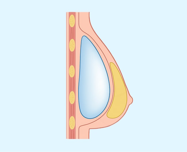 breast lift 