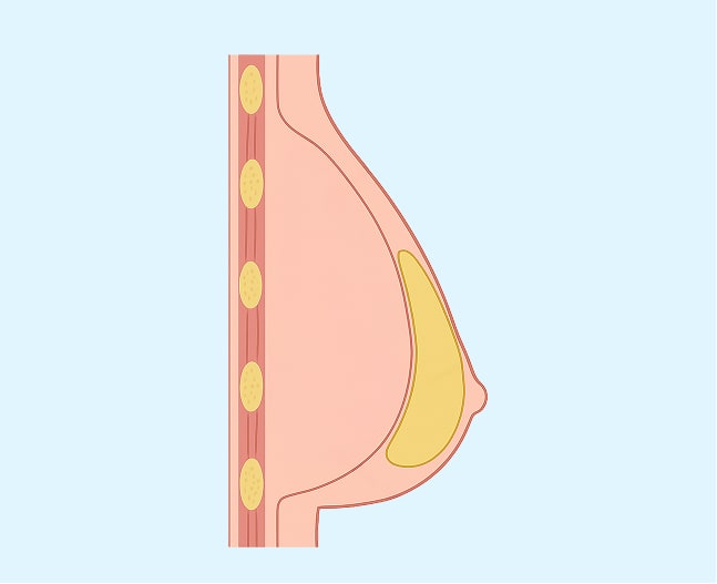 breast lift 