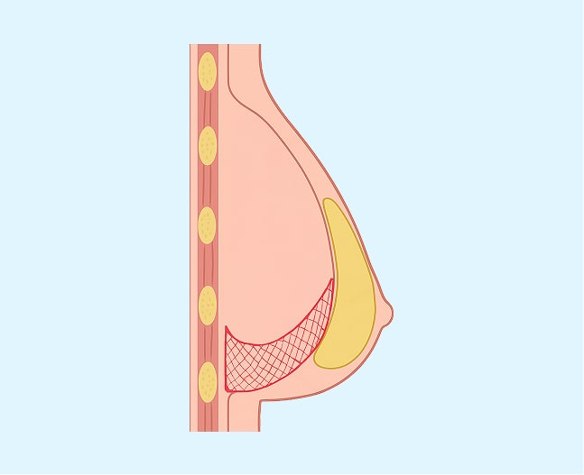 breast lift 