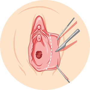 labiaplasty 