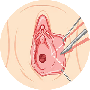 labiaplasty 