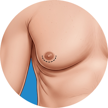 gynecomastia 