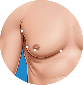 gynecomastia 