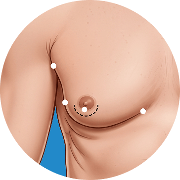 gynecomastia 