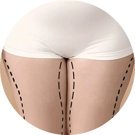 Lipo