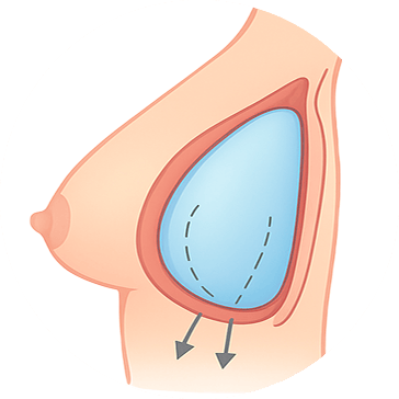 capsulotomy