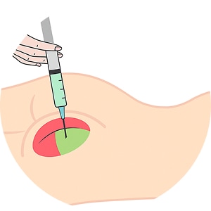 non surgical bbl