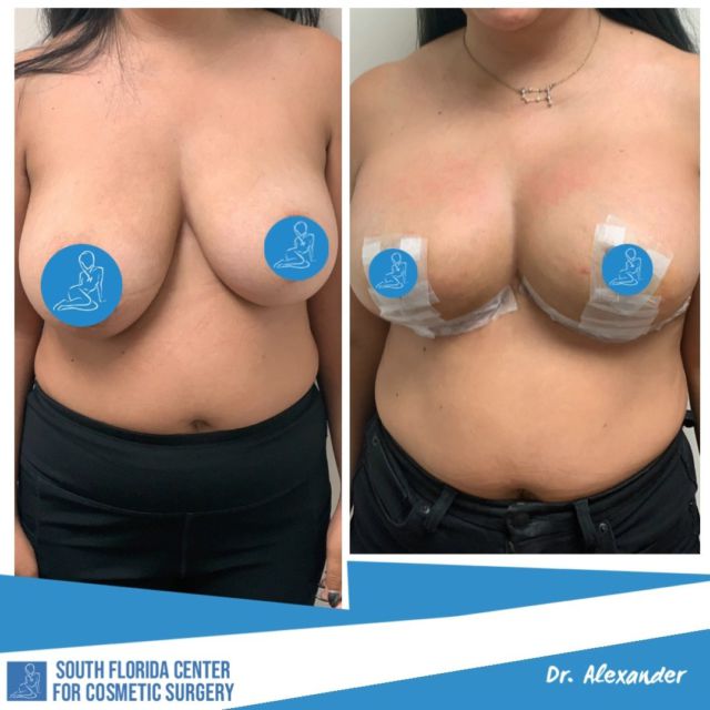 More beautiful work from @drtalexander! 😍This patient underwent a slight breast reduction with implants to enhance her breasts and give a more perky and even look. She is gorgeous before AND after! 
Comment below what surgery you've always wanted done. ⬇️⬇️

💎Procedure: Breast reduction & augmentation
💎Implant: 295cc of silicone 
💎Post-op: 2 weeks
💎Surgeon: Dr. Alexander

___________________________________________
#surgery #plastic #plasticsurgery #breastaugmentation #breastreduction #medical #cosmetic #cosmeticsurgery #transformation #beautiful #silicone #siliconeimplants #surgeon #plasticsurgeon #florida #southflorida #FCCS #implants #saline #salineimplants #boobjob #explore #explorepage