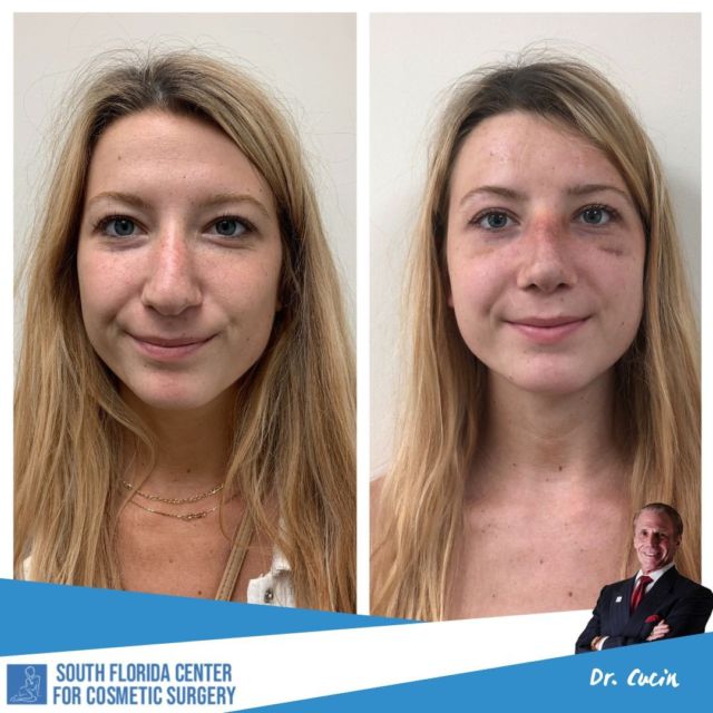 The nose job KING did it again! 👑Incredible rhinoplasty transformation by @drcucin 

🔷 Patient is only one week post op! 

Make sure to take advantage of your FREE virtual consultation today! 

#nosejob #rhinoplasty #beforeandafter #transformation #plasticsurgery #cosmeticsurgery #surgery #southflorida #plasticsurgeons #southflorida #explore #explorepage