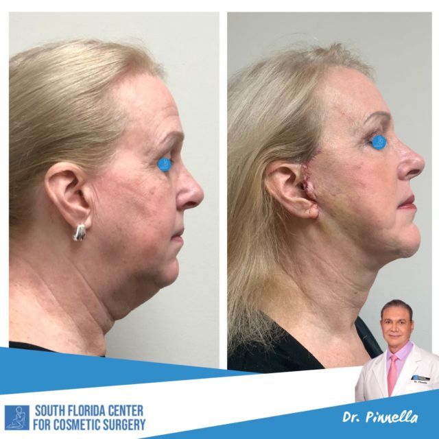 Liposuction of the jawline with a mini facelift is the perfect combination to create a more defined silhouette & rejuvenate the overall profile and shape of the face!

🔷 Patient is 6 days post-op

___________________________________________
#plasticsurgery #surgery #rejuventation #facelift #necklift #plasticsurgeons #liposuction #beforeandafter #transformation #jawline #jawlinecontouring #explore #explorepage #southflorida #cosmeticsurgery