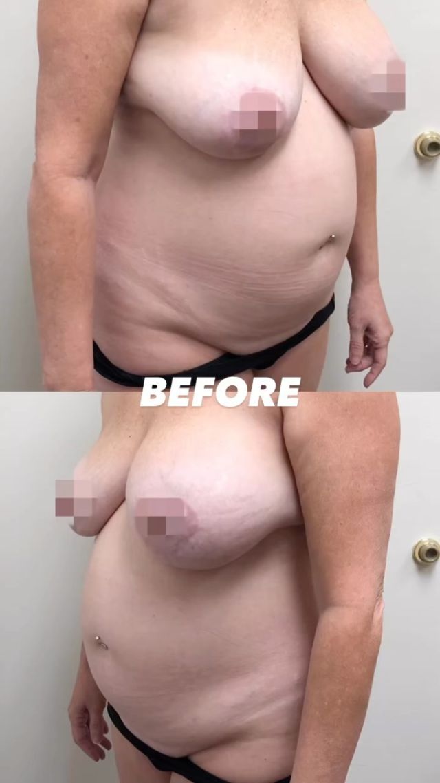 🚨 Body Transformation 

Our beautiful patient is looking incredible following her Tummy Tuck + Breast Augmentation 🍒
 
Achieve lifted, fuller breasts and a more feminine body contour… this is Mommy Makeover 🤩

Click our LINK IN BIO for a Free Online Consultation 
#tummytuck #liposuction #plasticsurgery #florida