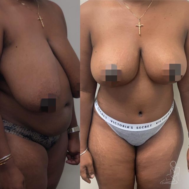 What do you think about this transformation? 🔥💣 Tummy Tuck + Breast Reduction by @drjohnpinnella 

#tummytuck #tummytuckrecovery #breastreductıon #plasticsurgery #plasticsurgeon #transformation #fortlauderdale #miami #southflorida